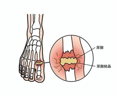 痛風ってちゃんと知ってる？